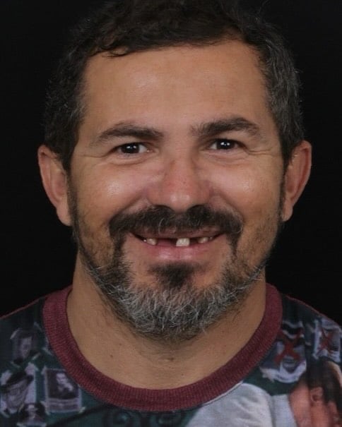 ✨Transformação completa do sorriso do nosso paciente José Neilson!✨Ele nos conheceu ao acompanha